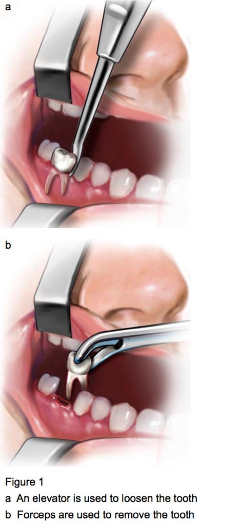 Figure 1 - Tooth removal