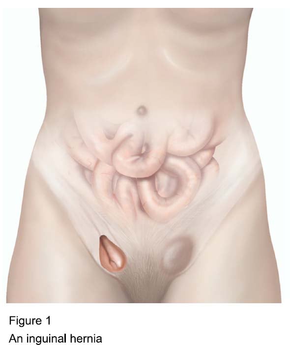 https://www.newvictoria.co.uk/sites/default/files/images/Figure%201%20-%20An%20inguinal%20hernia.jpg