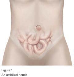 Umbilical Hernia Treatment London