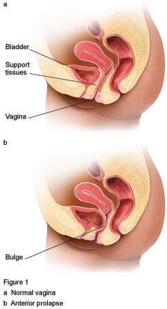 Vaginal Discharge - Philippe de Rosnay